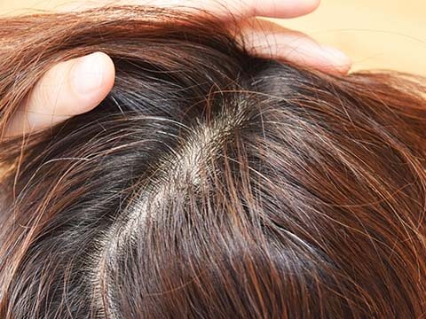 女性の 生え際 の悩み 公式 女性の薄毛治療専門病院 Agaスキンクリニック レディース院 Faga