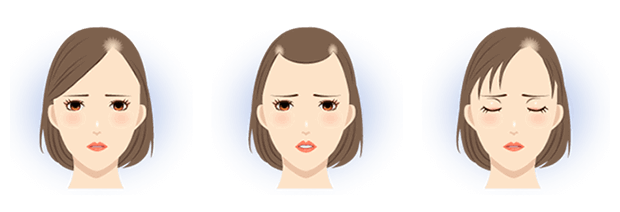 女性が気になる こめかみハゲ あまり知られていない こめかみ薄毛 の原因と対策 公式 女性の薄毛治療専門病院 Agaスキンクリニック レディース院 Faga