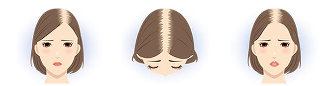 女性が気になる こめかみハゲ あまり知られていない こめかみ薄毛 の原因と対策 公式 女性の薄毛治療専門病院 Agaスキンクリニック Aスキ レディース院 Faga