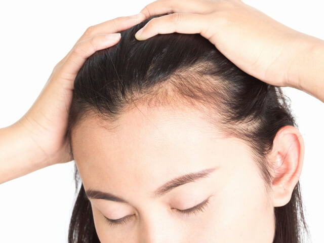 女性の薄毛のタイプと、それに合わせた対処法をご紹介