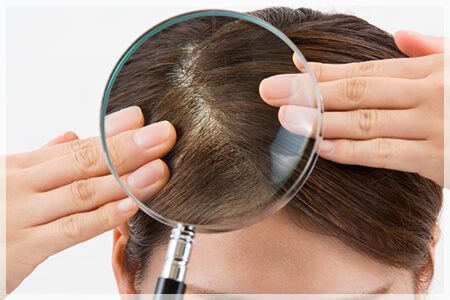 頭頂部やつむじの薄毛が気になる原因とは？