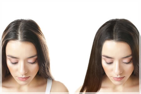 女性の薄毛への対処法「自毛植毛」の特徴3つ