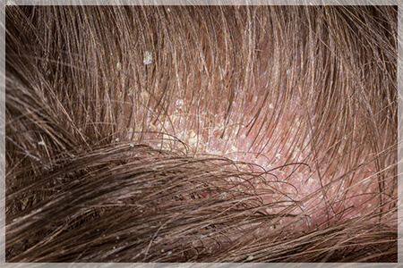 脂漏性脱毛症の症状
