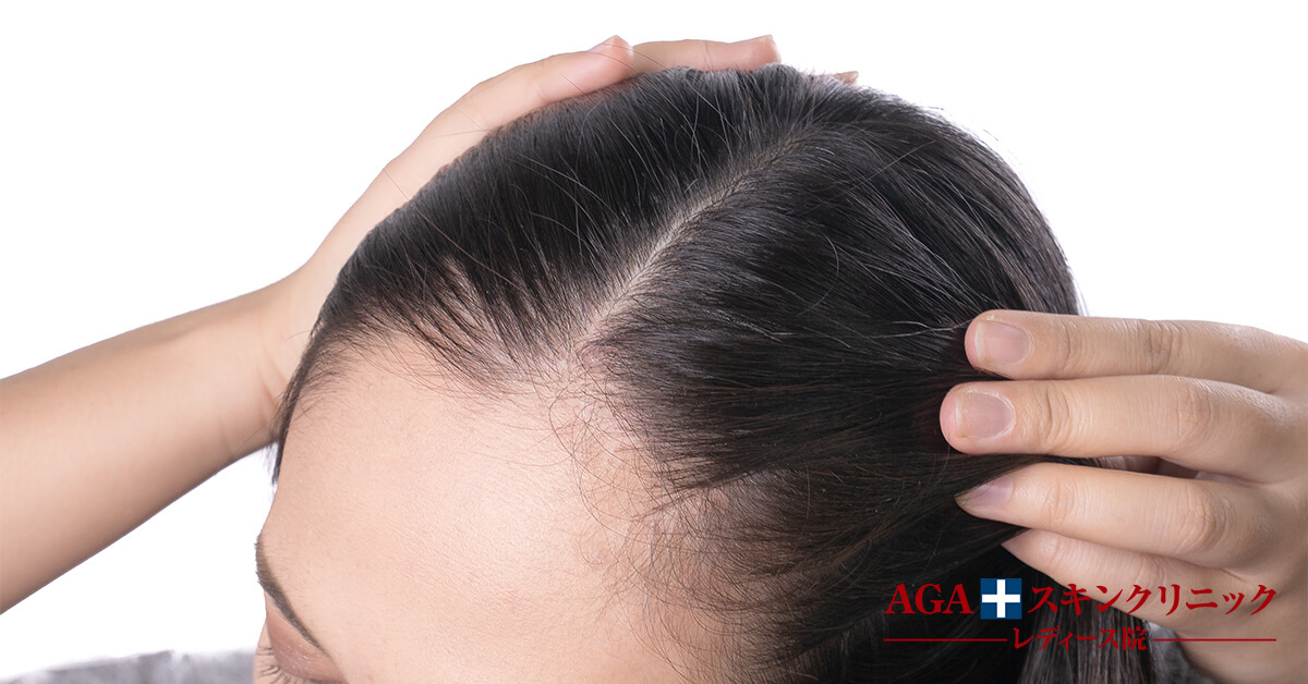 【医師監修】壮年性脱毛症とは。原因や症状、改善方法｜【公式】女性の薄毛治療専門病院 AGAスキンクリニック レディース院[FAGA]