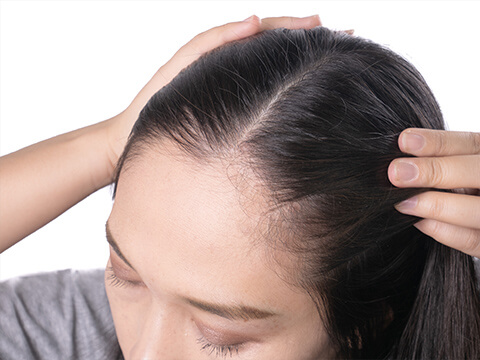 【医師監修】壮年性脱毛症とは。原因や症状、改善方法