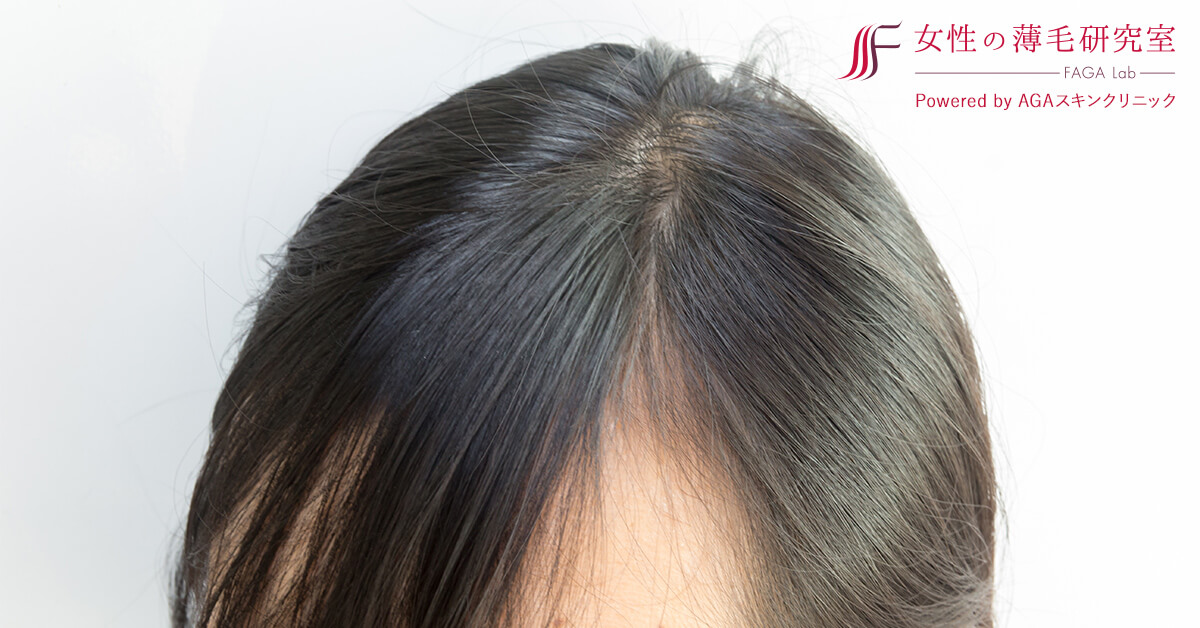 医師監修 前髪が薄い女性向けの対策と目立たないヘアスタイル 公式 女性の薄毛治療専門病院 Agaスキンクリニック Aスキ レディース院 Faga
