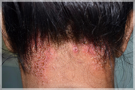 【医師監修】頭皮のカビが原因で起こる脂漏性皮膚炎とは