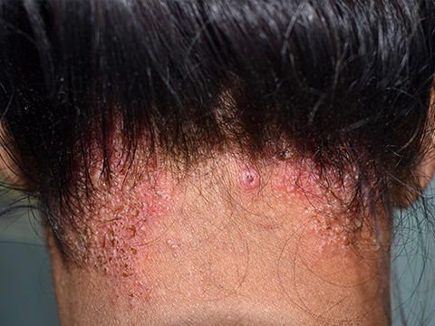 【医師監修】頭皮のカビが原因で起こる脂漏性皮膚炎とは