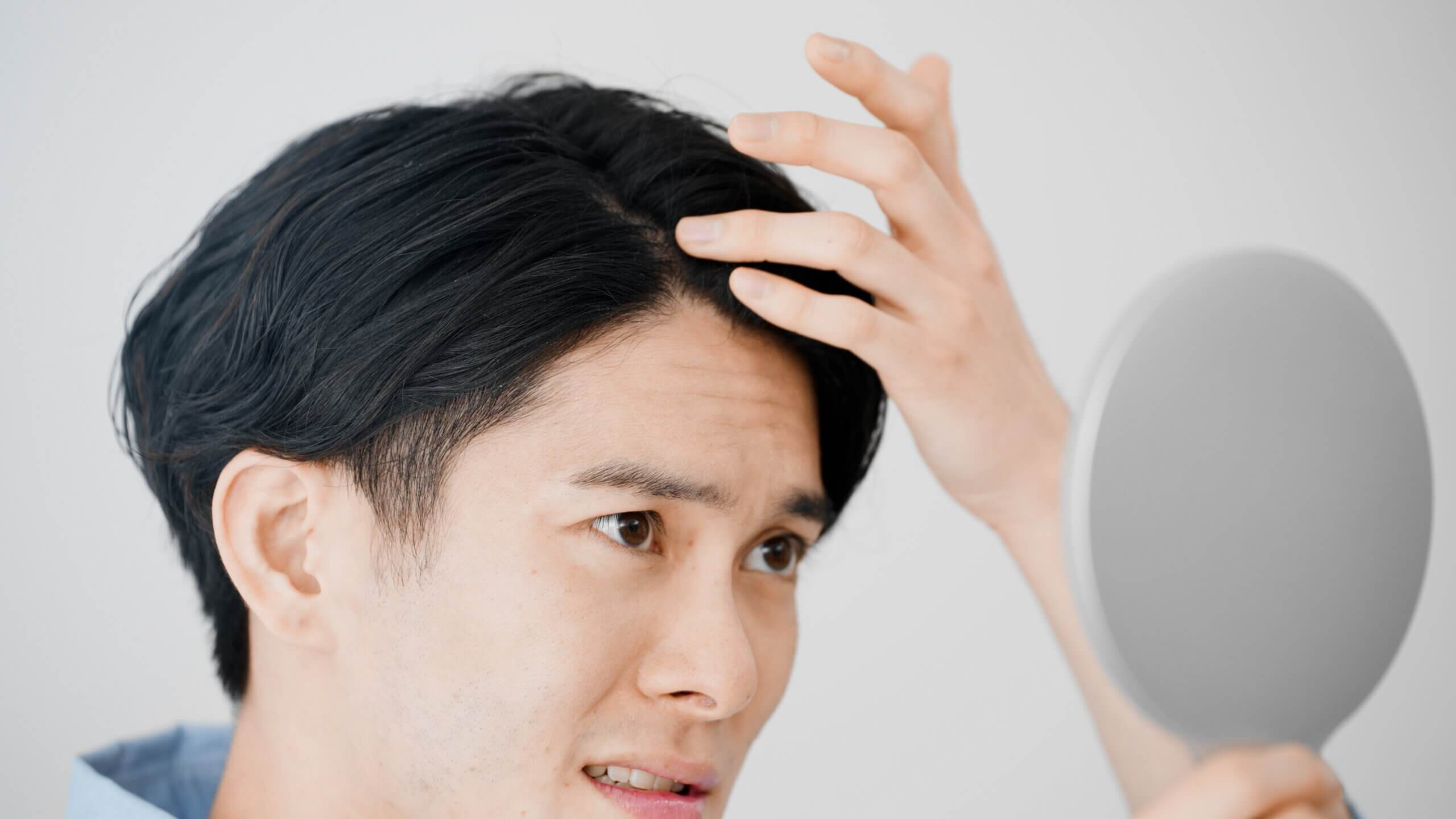 頭頂部や額から脱毛していく男性の薄毛