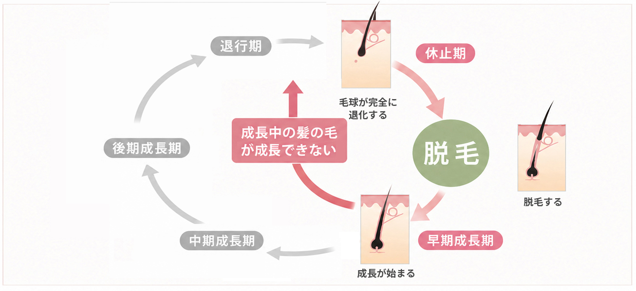 ヘアサイクルが乱れると、髪の成長が始まる早期成長期後に毛球が退化し、髪の毛が成長できずに短くて柔らかい髪の毛が抜ける