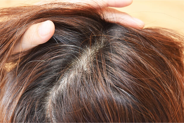 びまん性脱毛症とは？女性に多い脱毛症の原因と予防方法について解説