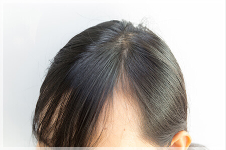 【医師監修】前髪が薄い女性向けの対策と目立たないヘアスタイル