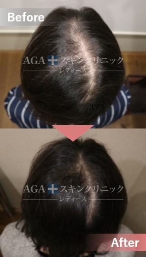 リバースレディ＋ミノキジェット|頭頂部・つむじの薄毛治療症例|30代女性