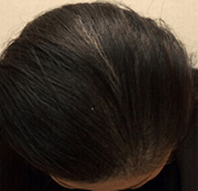 薄毛治療の症例写真