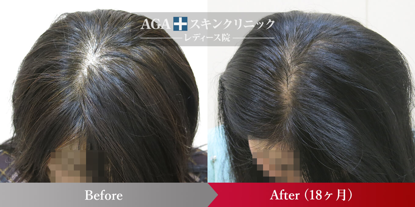 女性の発毛症例一覧 公式 女性の薄毛治療専門病院 Agaスキンクリニック レディース院 Faga 女性の発毛症例一覧 公式 女性の薄毛治療専門病院 Agaスキンクリニック レディース院 Faga