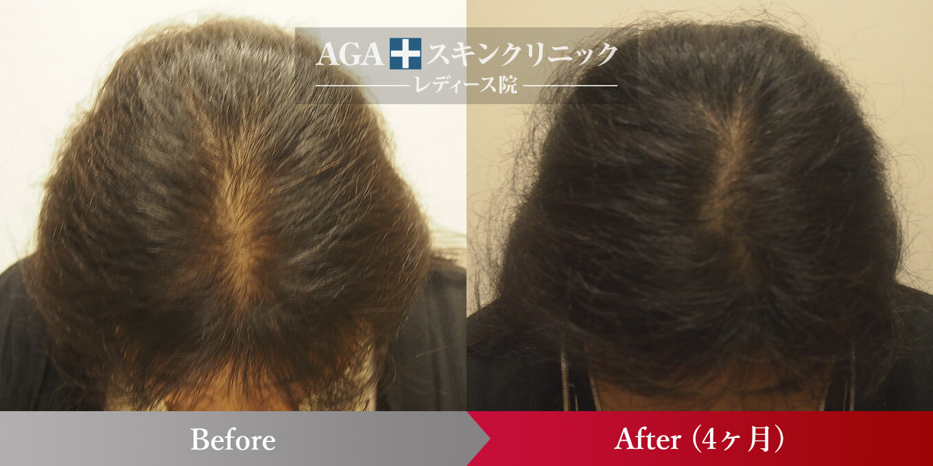 女性の育毛 発毛 薄毛治療の症例一覧 公式 女性の薄毛治療専門病院 Agaスキンクリニック Aスキ レディース院 Faga