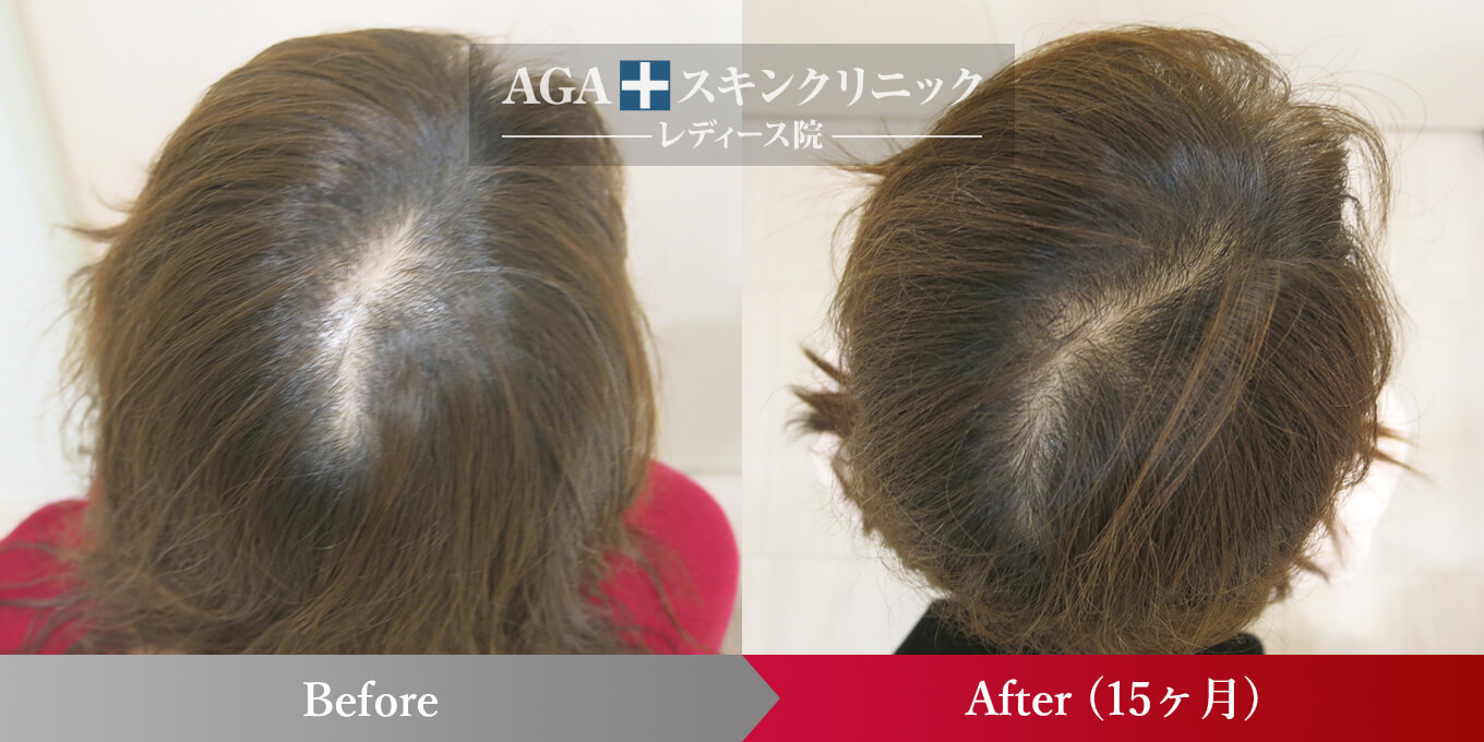 リバースレディ＋Dr’sメソ|頭頂部・つむじの薄毛治療症例|40代女性