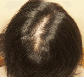 女性の発毛症例一覧 公式 女性の薄毛治療専門病院 Agaスキンクリニック レディース院 Faga