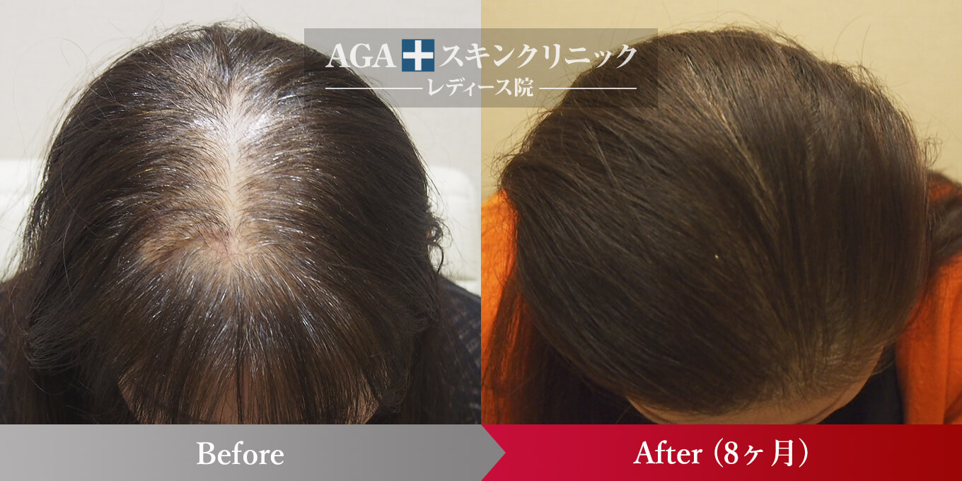 女性型AGA進行度レベル高の症例