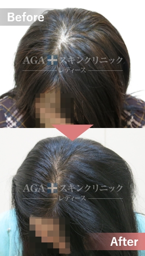 公式】AGAスキンクリニックレディース（Aスキ） - 女性の薄毛・抜け毛