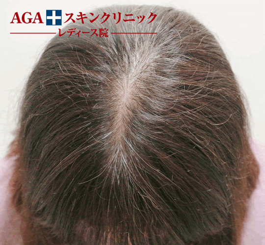 After(6ヶ月後)