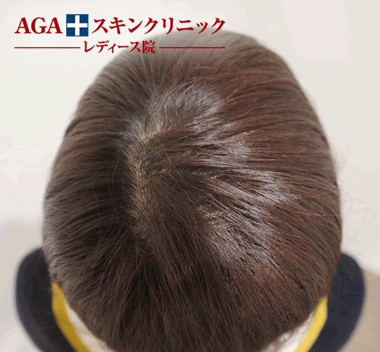 After(3ヶ月後)