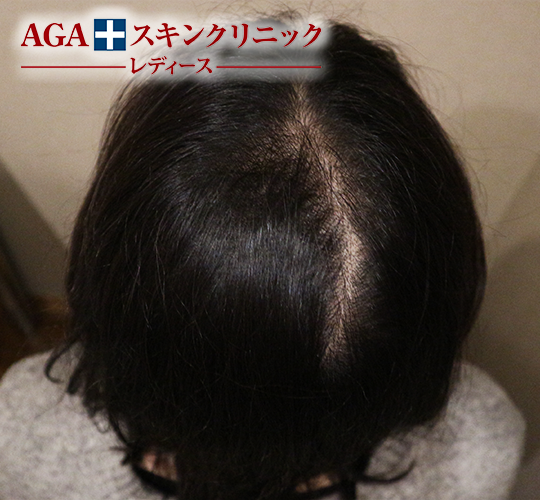 After(4ヶ月後)
