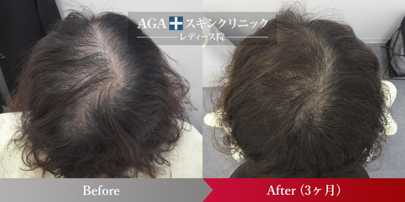 Agaスキンクリニック 川崎院 女性専用入り口あり 神奈川県川崎市 公式 女性の薄毛 抜け毛治療ならagaスキンクリニック レディース院 Faga Agaスキンクリニック 川崎院 女性専用入り口あり 神奈川県川崎市 公式 女性の薄毛 抜け毛治療ならagaスキンクリニック レディース院 Faga