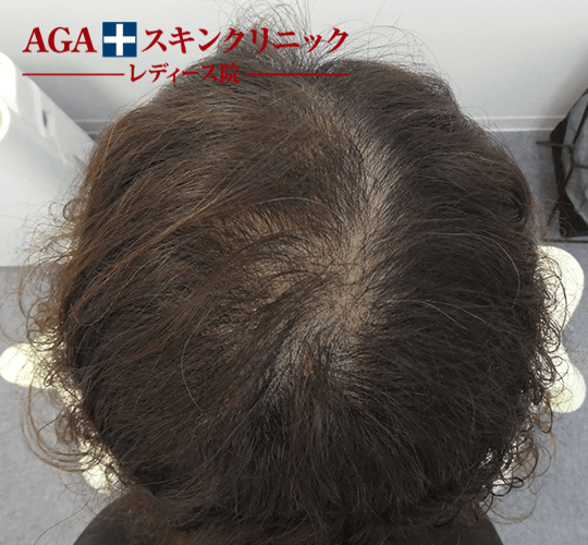 After(3ヶ月後)