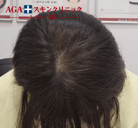 After(4ヶ月後)