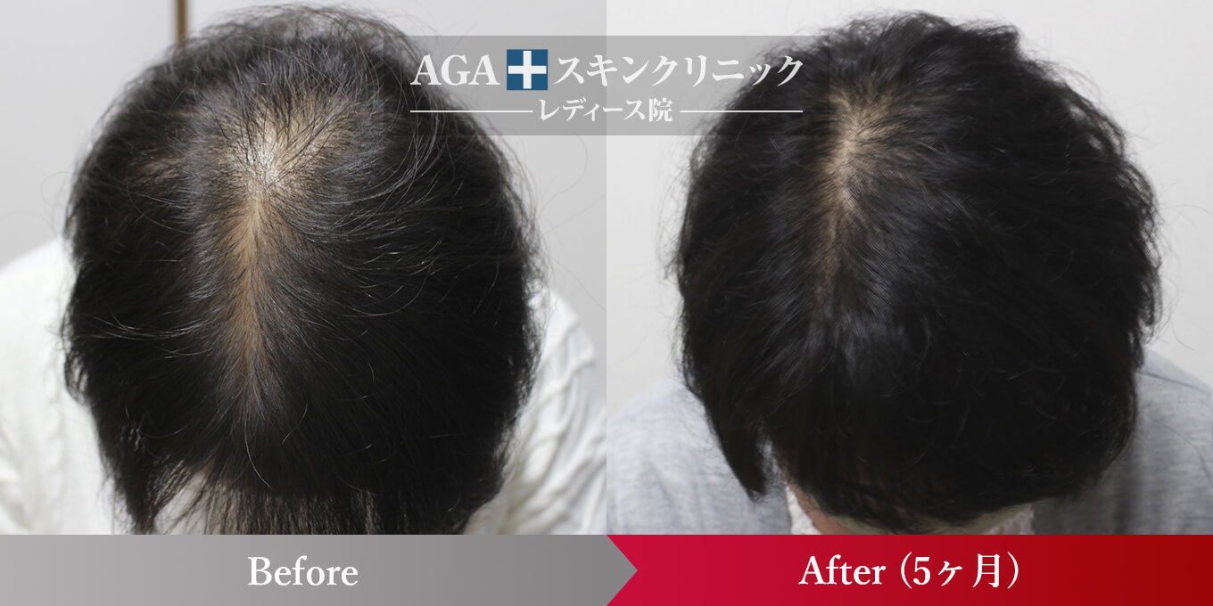 女性の発毛症例一覧 公式 女性の薄毛治療専門病院 Agaスキンクリニック レディース院 Faga 女性の発毛症例一覧 公式 女性の薄毛治療専門病院 Agaスキンクリニック レディース院 Faga