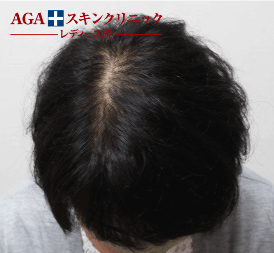 After(5ヶ月後)