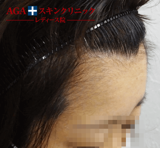 After(4ヶ月後)