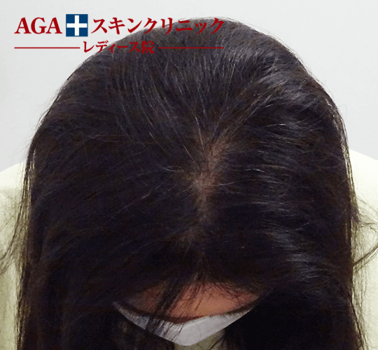 After(6ヶ月後)