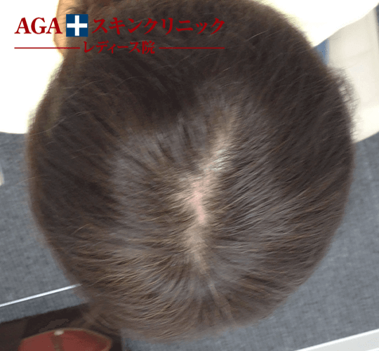After(6ヶ月後)
