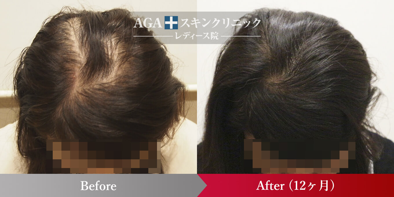 女性型AGA進行度レベルMAXの症例