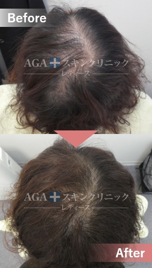 リバースレディ＋ミノキジェット|頭頂部・つむじの薄毛治療症例|50代女性