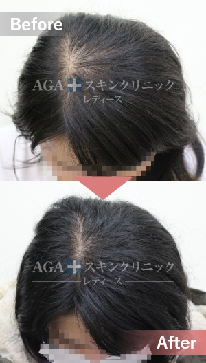 リバースレディ＋Dr’sメソ|頭頂部・つむじの薄毛治療症例|30代女性