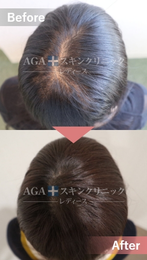 リバースレディ＋ミノキジェット|頭頂部・つむじの薄毛治療症例|40代女性