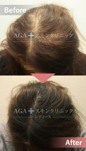 リバースレディ＋Dr’sメソ|頭頂部・つむじの薄毛治療症例|30代女性