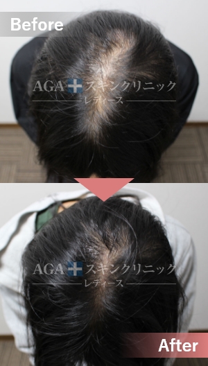 リバースレディ＋ミノキジェット|頭頂部・つむじの薄毛治療症例|20代女性