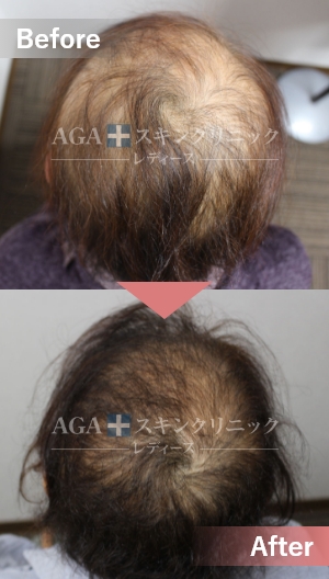リバースレディ＋Dr’sメソ|頭頂部・つむじの薄毛治療症例|60代女性