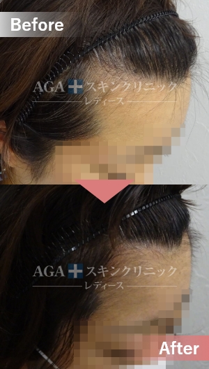 リバースレディ＋ミノキジェット|前頭部・生え際の薄毛治療症例|40代女性