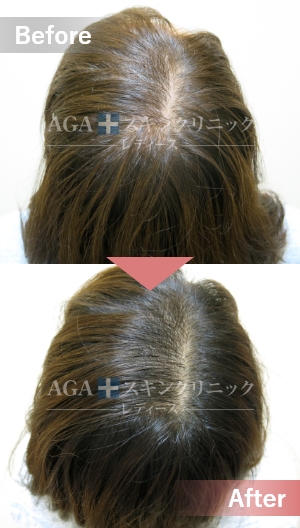 リバースレディ＋Dr’sメソ|頭頂部・つむじの薄毛治療症例|20代女性