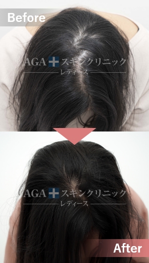 リバースレディ＋ミノキジェット|頭頂部・つむじの薄毛治療症例|30代女性