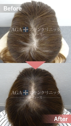 リバースレディ＋ミノキジェット|頭頂部・つむじの薄毛治療症例|20代女性
