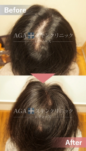 リバースレディ＋Dr’sメソ|頭頂部・つむじの薄毛治療症例|40代女性