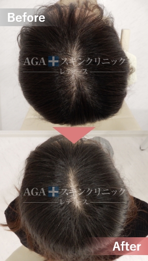 リバースレディ|頭頂部・つむじの薄毛治療症例|30代女性