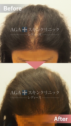 リバースレディ|頭頂部・つむじの薄毛治療症例|60代女性