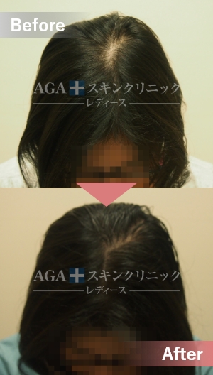 リバースレディ＋Dr’sメソ|頭頂部・つむじの薄毛治療症例|20代女性